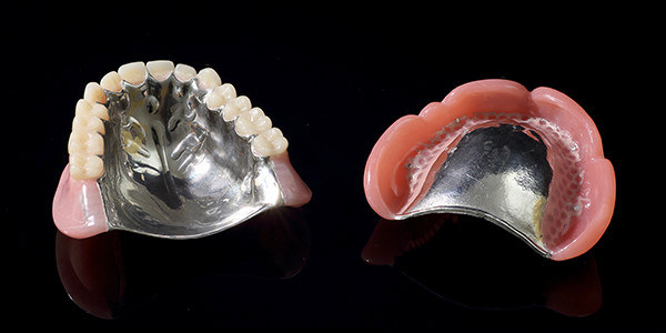 違和感や痛みの少ない金属床義歯